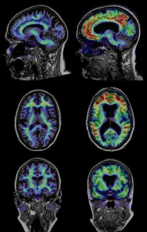 Brain