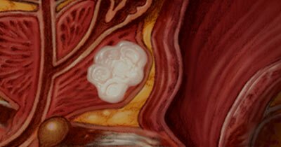 Prostate cancer